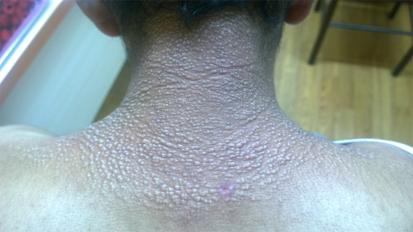 Ivory White Papular Skin Lesions with Hyperpigmented and Indurated Skin Overlaying It on the Upper Back