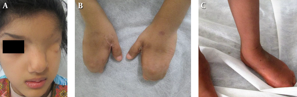 A, complete cryptophthalmos and a flat nose; B, bilateral cutaneous syndactyly, hands; C, unilateral cutaneous syndactyly, left foot.