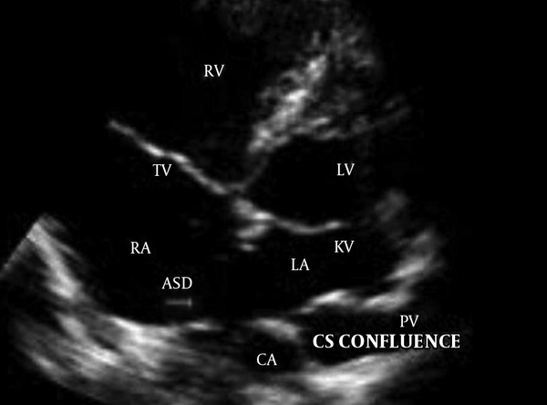 Apical four-chamber view showed common pulmonary chamber (CPC)/confluence of pulmonary veins (CPV). An atrial septal defect (ASD) with 5mm in diameter was also evident.