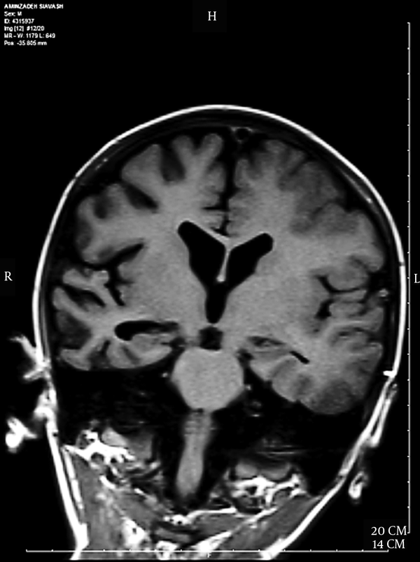 Mild Ventriculomegaly and Prominence of the Right Hemisphere Sulci Pointed to the Secondary Atrophic Changes From Longstanding Seizure