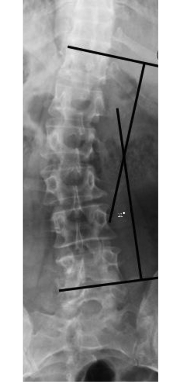 The X-Ray Performed After the Removal of the System Evidenced the Return to the Original Scoliosis Curvature (Cobb’s Angle 21°)