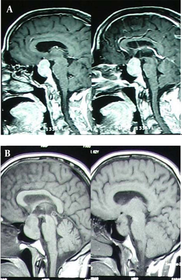 A, B: MRI (Sagital View)