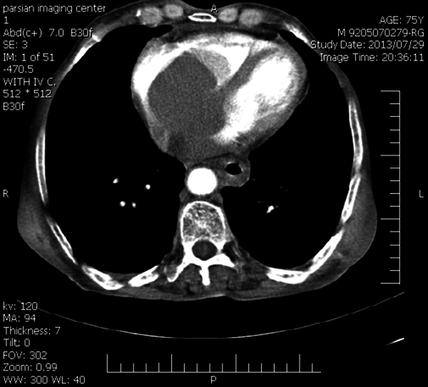 Intracardiac Mass on Thoracic CT Scan