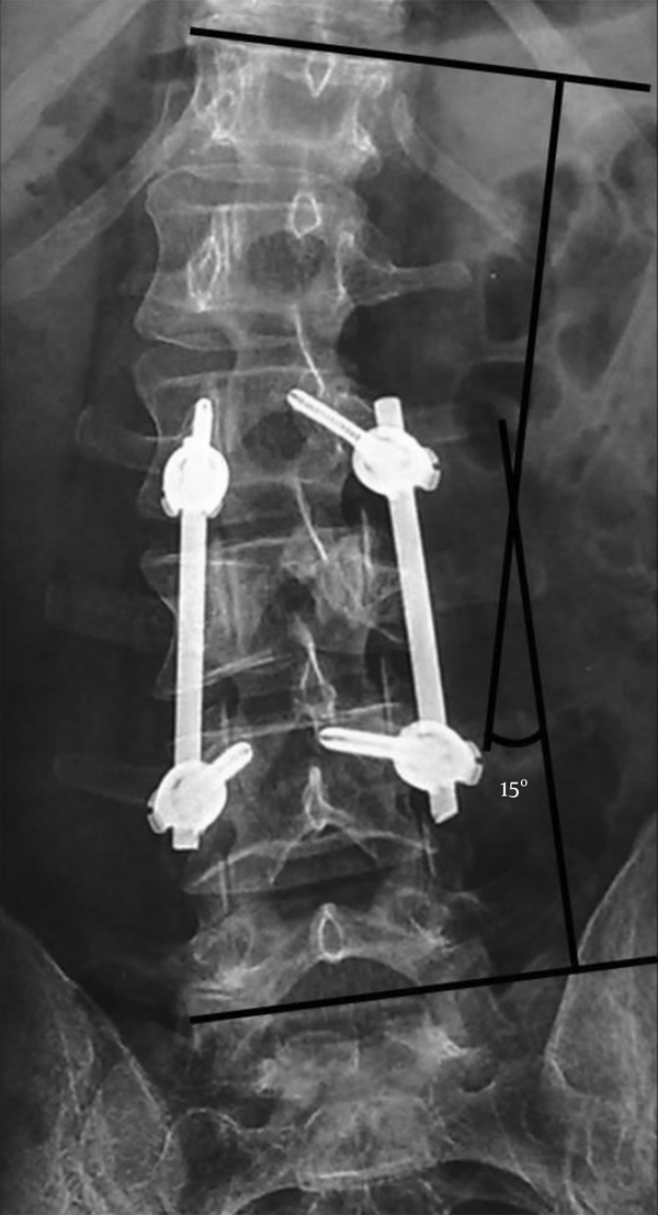 Post Operatory X-Ray Showing a Partial Realignment of the Pre-Existing Scoliosis (Cobbs’ Angle 15°)