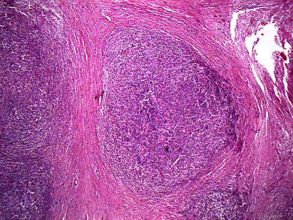 Histopathologic Feature of Nodular Sclerosis; (H & E, × 100)