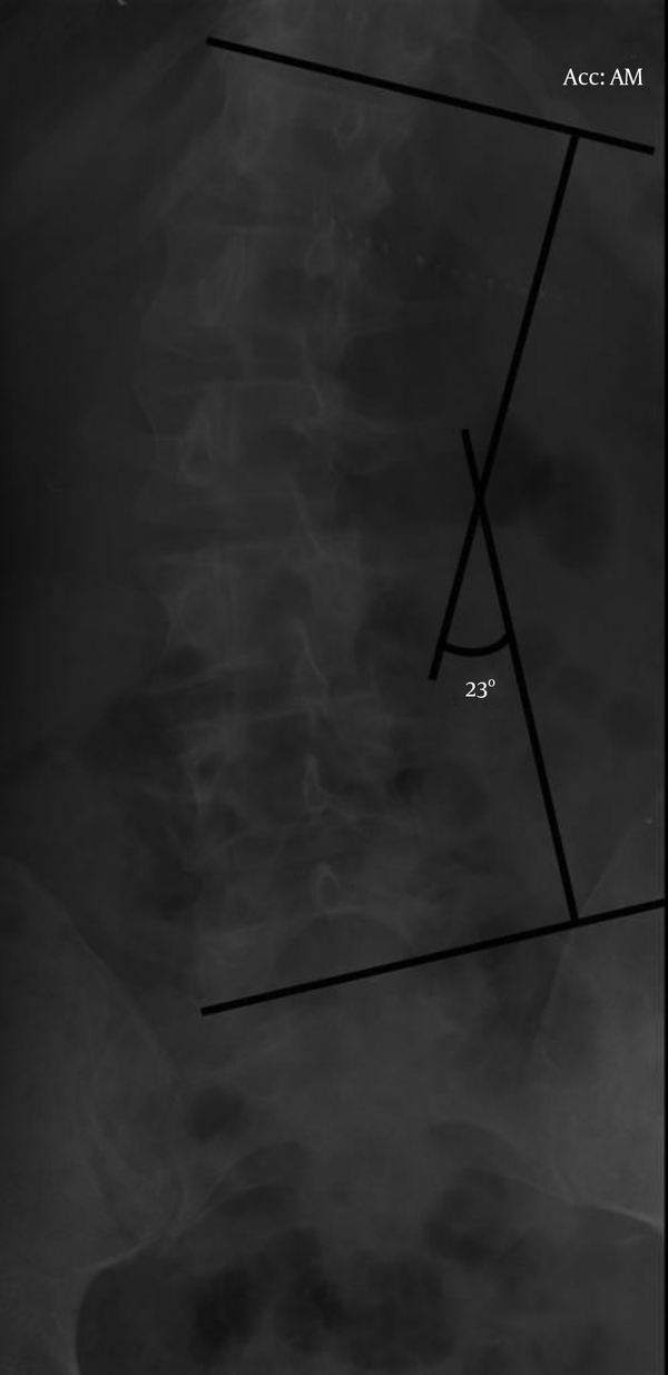 X-Ray Showing the Compensated Asymptomatic Idiopathic Scoliosis (Cobb’s Angle 23°)