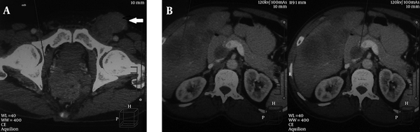 Contrast enhanced CT Scan showing: A, exophytic anorectal growth and conglomerate large lymph nodal mass in left inguinal region (solid white arrow); B, multiple hepatic metastasis.