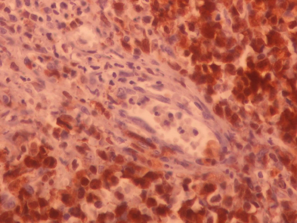 Cohesive Sheets of Relatively Monomorphic Atypical Cells With Round Vesicular Nuclei (H & E, × 400)