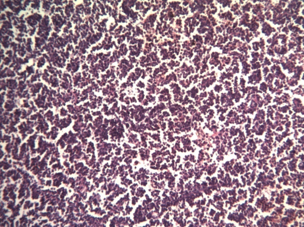 Diffuse Infiltration of Lymphoid Cells (H and E, × 100)