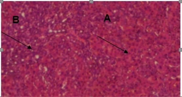 Liver section of a rat after BDL classic cirrhotic appearance with the presence of coagulative necrosis, mononuclear cell infiltration (small arrows), hemorrhage (h), microvesicular steatosis, and hydropic degeneration (large arrow); hematoxylin eosin staining; magnification × 100.