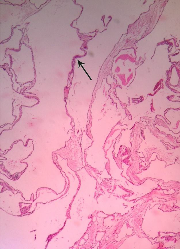 Dilated cystic spaces with flattened endothelial cell lining (black arrow) and filled by homogenous pink fluid. Dilated lymphatic channels of varying sizes, separated by thin septa within the pancreatic parenchyma have shown. Note the lymphoid has aggregated around the lymphatic channels.