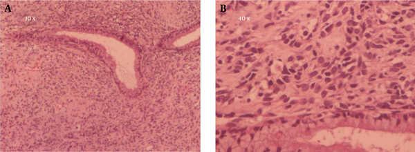 The Benign Edocervical Glands Surrounded By Pleomorphic Spindle to Round Cells with Dark Pyknotic Nuclei and Scant Cytoplasm in Abundant Loose Vascular Myxoid Stroma