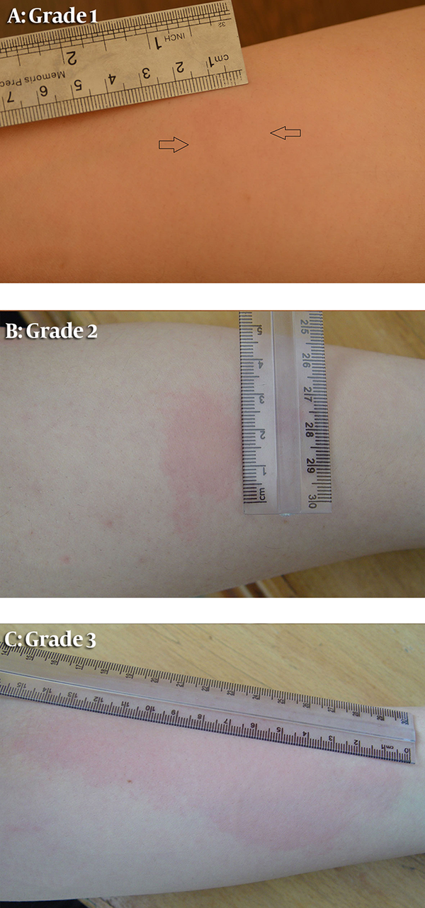 Skin Flush Response to Niacin Grading: A, grade 1; B, grade 2; C, grade 3 (11)