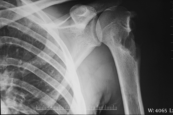Radiographic View of Left Upper Arm