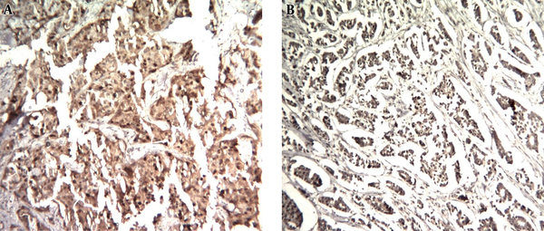 A, strong nuclear and cytoplasmic staining of most of neoplastic cells (H & E, 100 ×); B, strong nuclear and cytoplasmic staining of most of neoplastic cells (H & E, 100 ×).