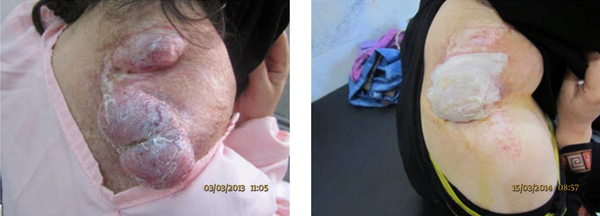 A Hudge Tender Soft Tissue Mass (Deamoid Tumor) on the Posterolateral Aspect of Neck and the Upper Part of Shoulder (left) and After 6 Months Treatment (Right)