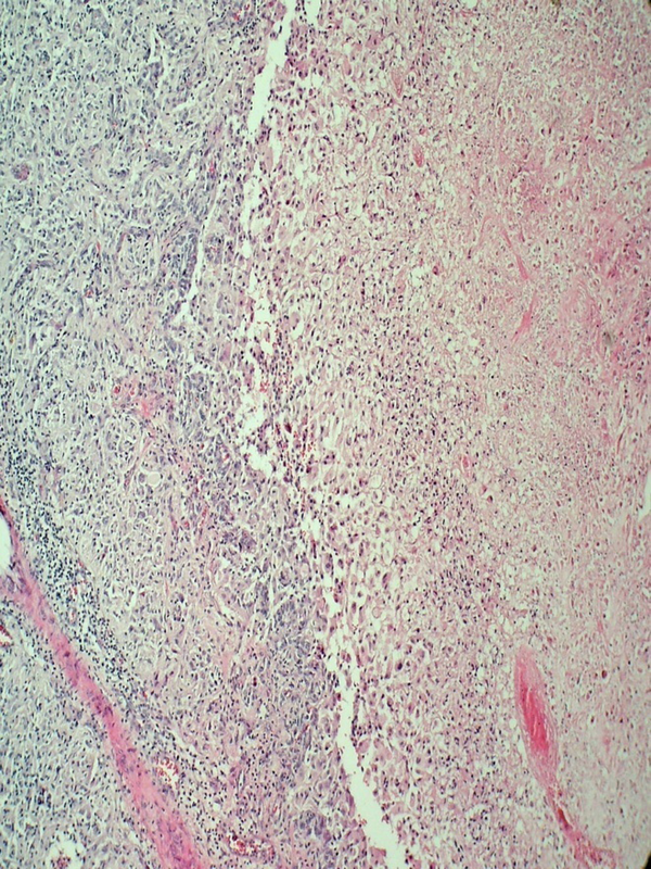 Tumoral Necrosis Surrounded by Viable Tumoral Cells and Proliferated Capillaries (H & E 100 ×)