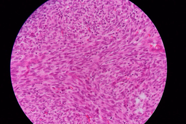 Proliferation of Neoplastic Cell