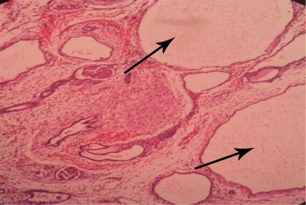 Arrows indicate cystic spaces in renal tissue.