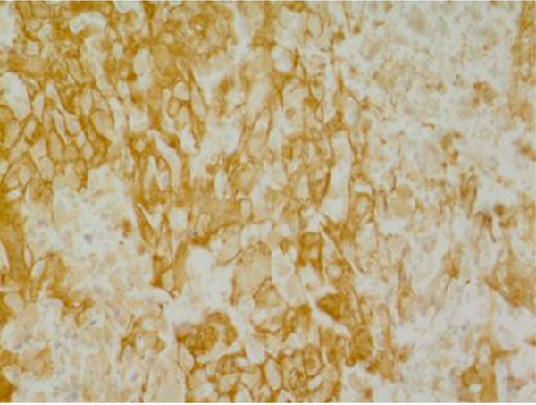 Immunohistochemical Staining for Epidermal Growth Factor Receptor (EGFR) in Serous Ovarian Carcinoma Tissue Showing Positive Expression of EGFR