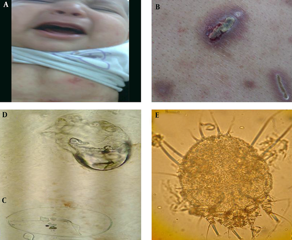 A, Erythematous Papules and Pustules on the Abdomen in a 4 Months Baby; B, Erosive Lesions in a Dialysis Patient; C, D, and E, Microscopic Sections of Skin Scraping with 10% KOH Showing Eggs, Nymph and Adult S. scabies Mite.