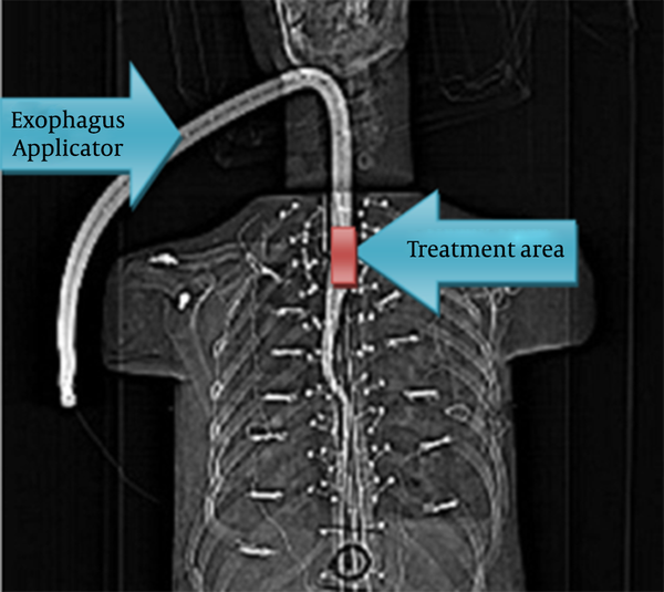 Computed Tomographic Scan of Phantom With Esophagus Applicator