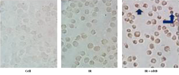 Apoptosis Induction in A549 by Combination Therapy: DNA Fragmentation Was Examined, Using an in Situ Cell Death Detection Assay (TUNEL). In Contrast to the Untreated cells and Irradiated cell, Apoptotic Bodies (Brown Nuclei Stained) Were Seen in the Treated Cells with a Combination of IR with cdtB