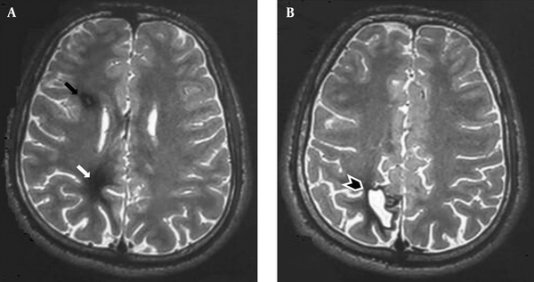 A and B, Axial T2-weighted MR image showing a small mass on the right deep posterior frontal lobe with a mixed intensity core surrounded by a low signal intensity hemosiderin rim (black arrow) in favour of a cavernous angioma and an ill-defined low signal intensity area in right deep posterior parietal lobe indicative of post-surgical gliosis (white arrow) with residual cystic lesion (black arrowhead).