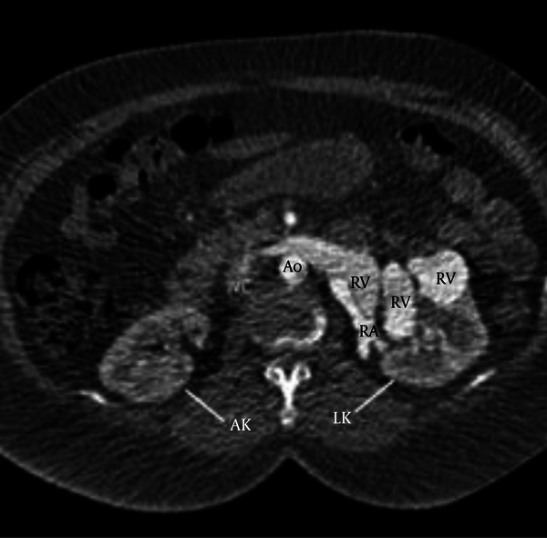 Contrast enhanced axial CT scan of the abdomen within the arterial phase showed dilatation of renal artery and renal vein and early filling of left renal vein almost at the same time of left renal artery filling most probably due to AVF. Ao = Aorta; LK = Left kidney; RA = Renal artery; RK = Right kidney; RV = Renal vein; IVC = Inferior vena cava.