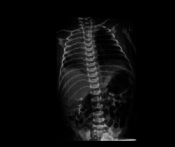 Chest Radiography Showed White Right Hemi Thorax with Right Mediastinal Shift