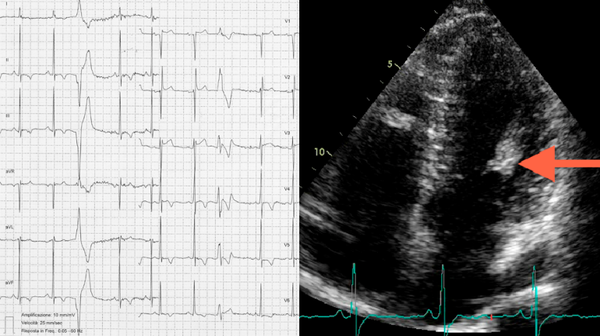 Left panel, electrocardiogram; Left ventricular hypertrophy with t-waves inversion in the inferior and lateral leads and ventricular premature beat; right panel, echocardiography; Apical 4-chamber views showing the hypertrophic and hyper-echoic anterolateral papillary muscle.
