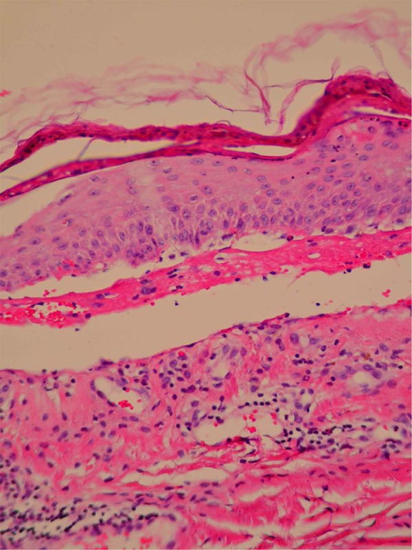 Histopathology of Skin Showing Full Thickness Epidermal Necrosis and Separation of the Dermis and Epidermis