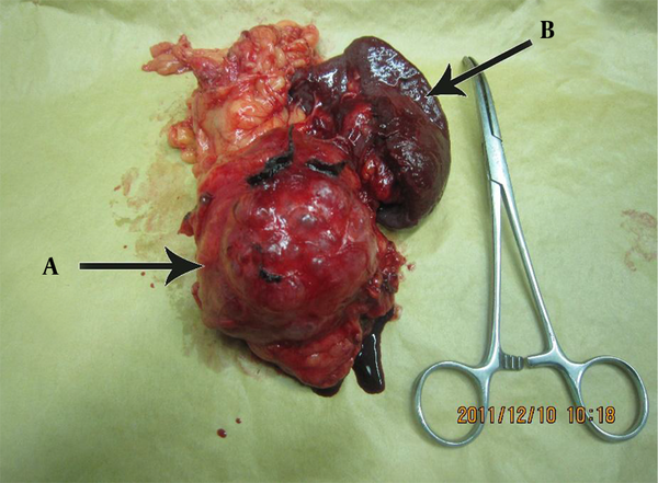 A,Surgical excision has revealed a nodular and cystic surface of the mass which has surrounded by normal pancreatic tissue; B,Resected spleen.