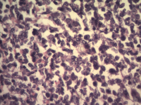 Small to Medium Sized Lymphoid Cells With Round to Irregular Nuclei and Some With Prominent Nucleoli (H and E, × 400)