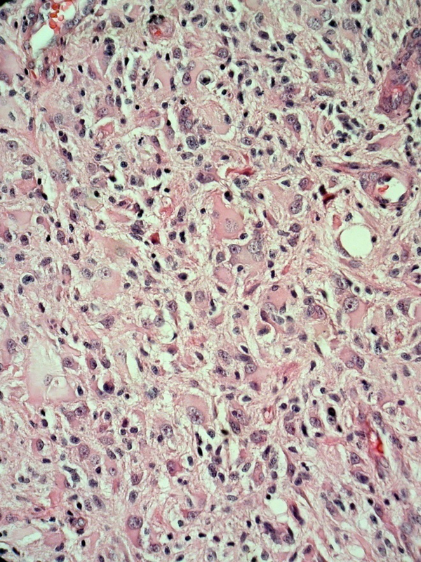 Highly Atypical Malignant Astrocytes (H & E 400 ×)