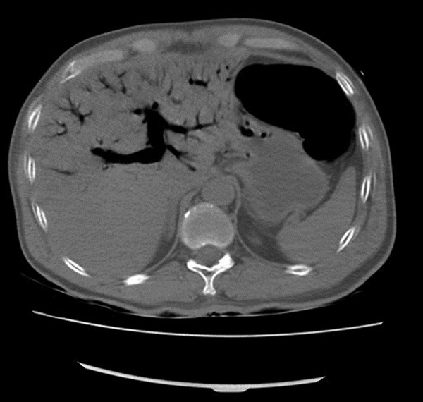 Massive Air Density in the Intrahepatic Portal Veins and Superior Mesenteric Vein (Due to Intestinal Ischemia and Rupture)