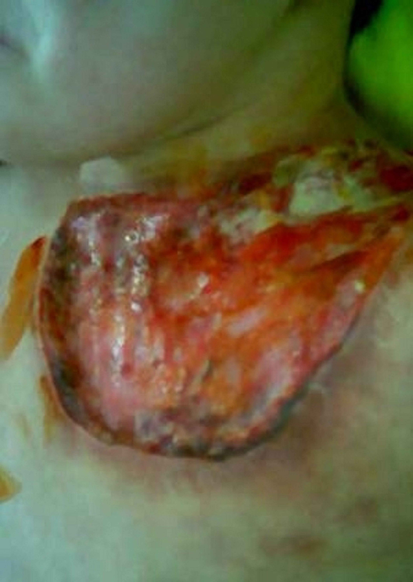 A large Necrotic Ulcer (20 × 10 Cm) on the Left Upper Chest of the Patient With a Normal Appearance