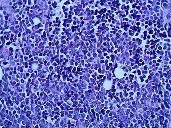 Histopathologic Feature of Diffuse Large B Cell Lymphoma; (H & E, ×
            400)