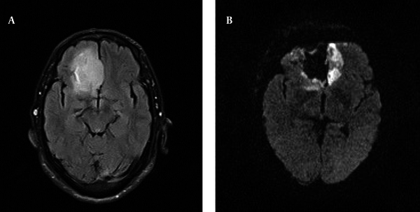 A, Pre-operative MRI of the second patient with right frontal lesion; B, Post-operative which shows complete tumor removal.