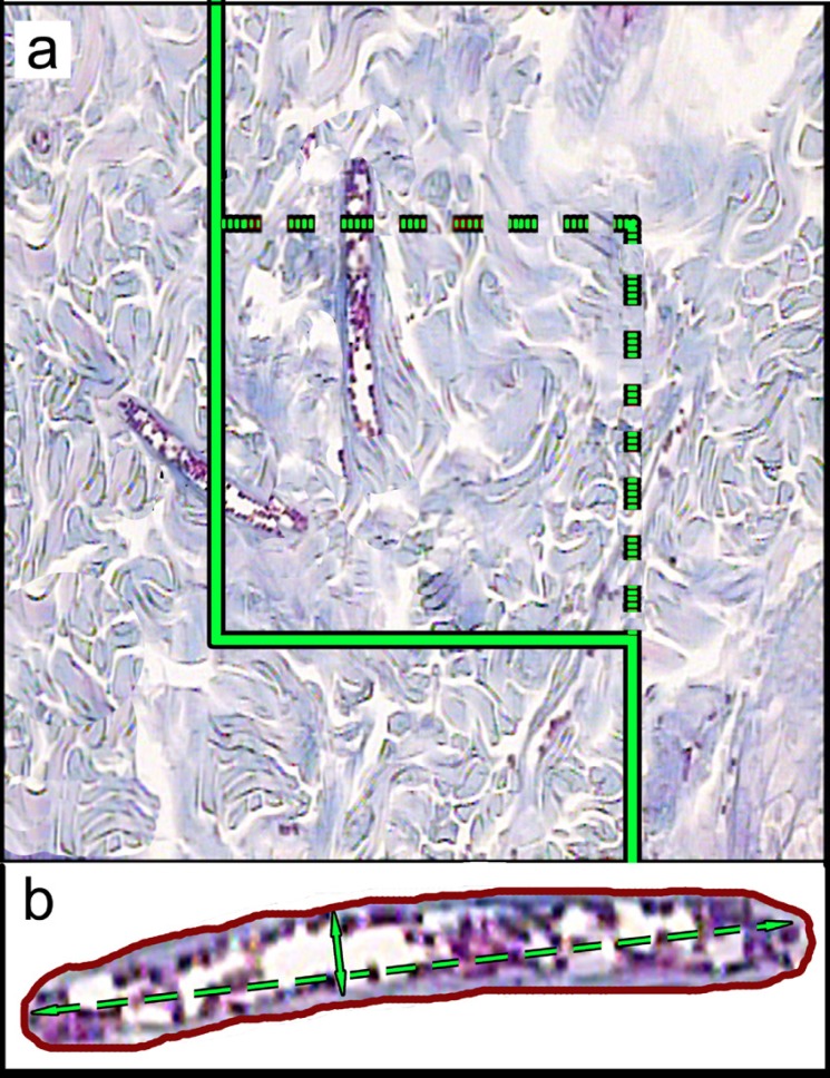 A: An unbiased counting frame is laid on the monitor image of wound dermis at final magnification of 450 randomly for estimation of the vessel’s length density (LV) and mean diameter. Any vessel lied in the counting frame or touched the inclusion borders (dotted lines) are selected. The vessels touched the exclusion borders (bold continuous lines), are omitted. B: Mean diameter of the vessel is estimated by measuring the short axis of the vessel (short double arrow). (Hedenhain’s azan stain