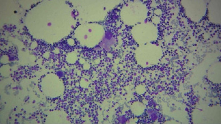 The bone marrow aspiration sample (*10) demonstrating the sufficient cellularity and megakaryocytes