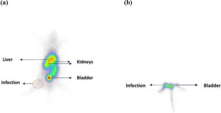 Scintigraphy of mice with right thigh muscle staphylococcus aureus infection 1 h post injection of 99mTc(CO)3-Gemifloxacin. (a) hole body scan (b) Infection site (arrow show) after masking of abdominal region