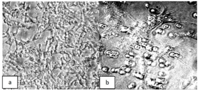 Phase contrast photomicrographs of ovarian tumor cells derived from patient 1, and cultured for 6 days in (a) control media or (b) media containing paclitaxel plus carboplatin