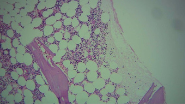 The bone marrow biopsy sample (*4) demonstrating sufficient cellularity and megakaryopoiesis