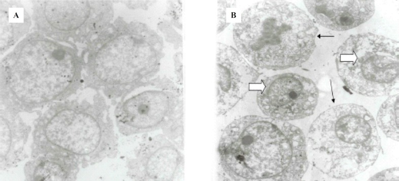 (a) Untreated HL60 cells. (b) 24 h. ICD-85 treated HL60 cells. Cell sections marked change in nuclear/cytoplasmic ratio, condensing nuclear material peripherally (large arrow), increased cytoplasmic vacuoles, and reduction or disappearance in cytoplasmic process (small arrows) was seen in comparison in ICD-85 treated cells. Magnification (4800 X).