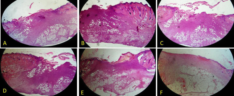 H&E staining of a wound area on days 7. A: Control, B: Control of diabetes, C: nanofiber-Chitosan/Polyvinyl alcohol, D: nanofiber-Chitosan/Polyvinyl alcohol/Doxycycline, and E: film-Chitosan/Polyvinyl alcohol, and F: film-Chitosan/Polyvinyl alcohol/Doxycycline (4X)