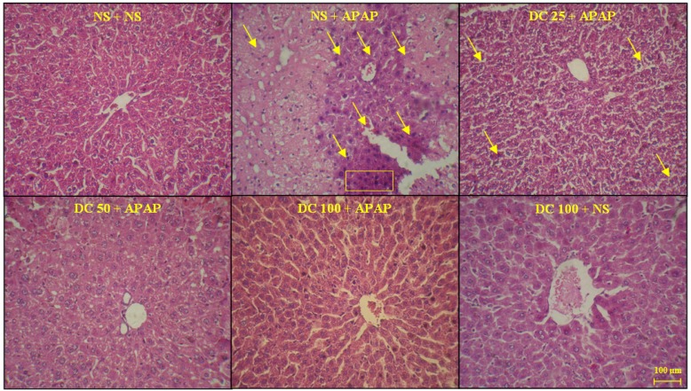 The liver sections about protective effects of doxycycline (DC) on hepatotoxicity of APAP in mice 24 h after APAP. The animals were treated with DC 25, 50 and 100 mg/kg or normal saline (NS) just before APAP 400 mg/kg (H&E x300)