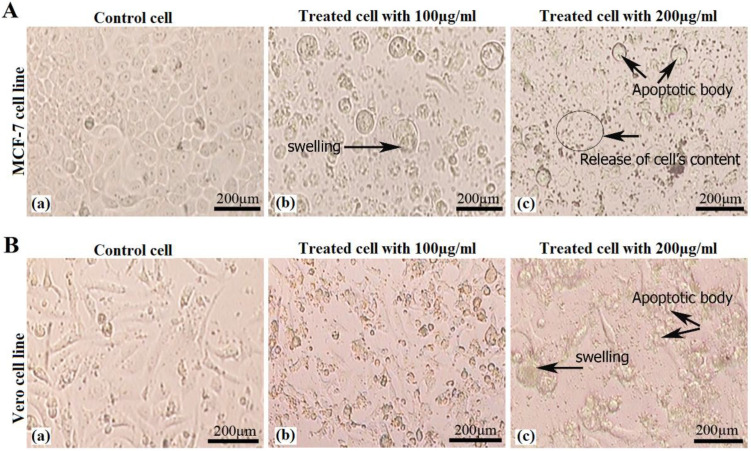 Morphological changes in (A) MCF-7 cell line: control cell, treated cell with 100 µg/mL and treated cell with 200 µg/mL of crude venom, and (B) Vero cell lines: control cell, treated cell with 100 µg/mL and treated cell with 200 µg/mL of crude venom. Pictures of treated cell groups showing increased cell content, swelling and apoptotic bodies (showed with arrows).
