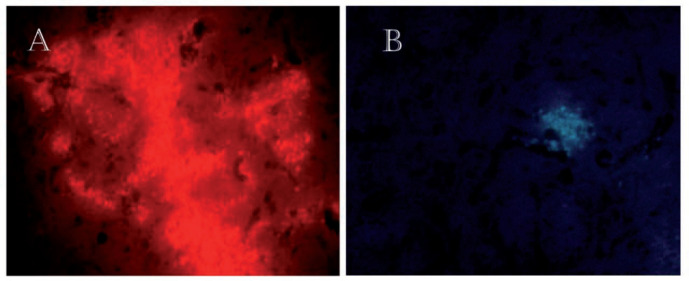 To ensure the survival of transplanted Sertoli cells in the striatum, 14 days after the injection, were tracked by fluorescence microscopy. (A) The injected cells into the striatum were labeled with DiI. × 40. (B) The transplanted cells were stained with Hoechst and injected into the striatum. × 20. These figures approve survival of Sertoli cells 14 days after transplantation