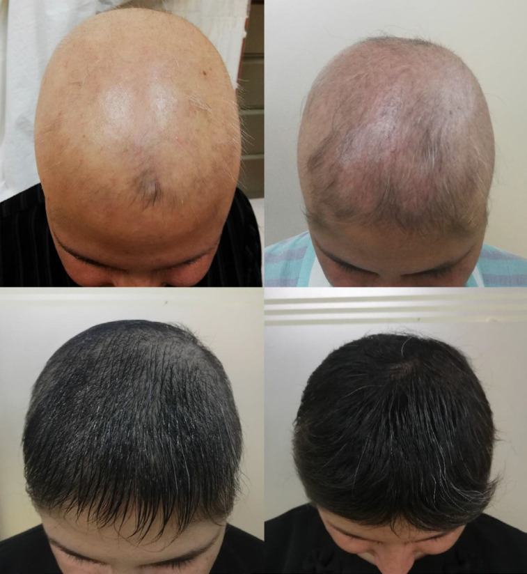Disease improvement in the combination therapy group after nine months of treatment. (A) Pretreatment, (B) Three months after the treatment, (C) Six months after the treatment, and (D) Nine months after the treatment